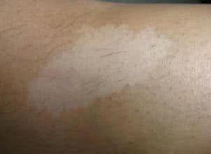 白癜风图片 白癜风图片